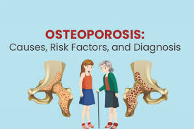 Read more about the article Osteoporosis in 2025 – Causes, Symptoms, Prevention & Natural Support